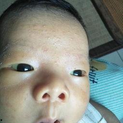 眼珠子发黄图片,揭秘健康警示信号